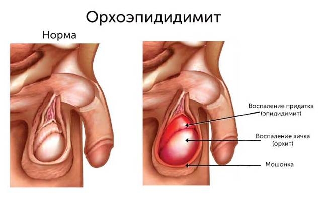Орхит яичка у мужчин: симптомы и лечение, причины болезни