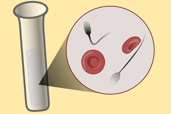 Кровь в сперме у мужчин: причины и лечение, что это означает?