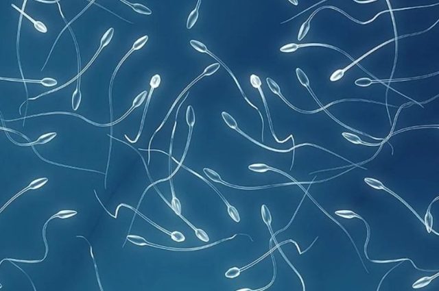 Агрегация сперматозоидов у мужчин в спермограмме: что значит, причины и лечение