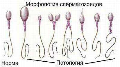 Агглютинация сперматозоидов в спермограмме у мужчин: степени, причины, лечение