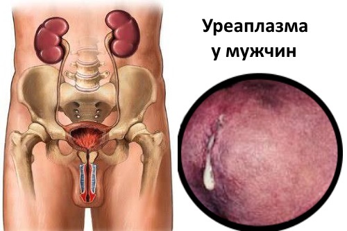 Уреаплазмоз (уреаплазменная инфекция) у мужчин: признаки, симптомы, лечение