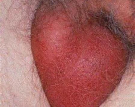 Орхит яичка у мужчин: симптомы и лечение, причины болезни