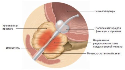 Кавернозный фиброз: симптомы (фото у мужчин), лечение